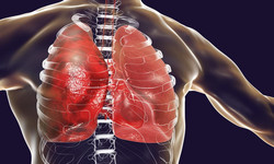 Inhalacje z soli fizjologicznej - co to, kiedy wykonywać, a kiedy są niewskazane?