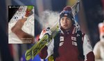 Kamil Stoch pokazał zdjęcie kostki. To nie jest przyjemny widok