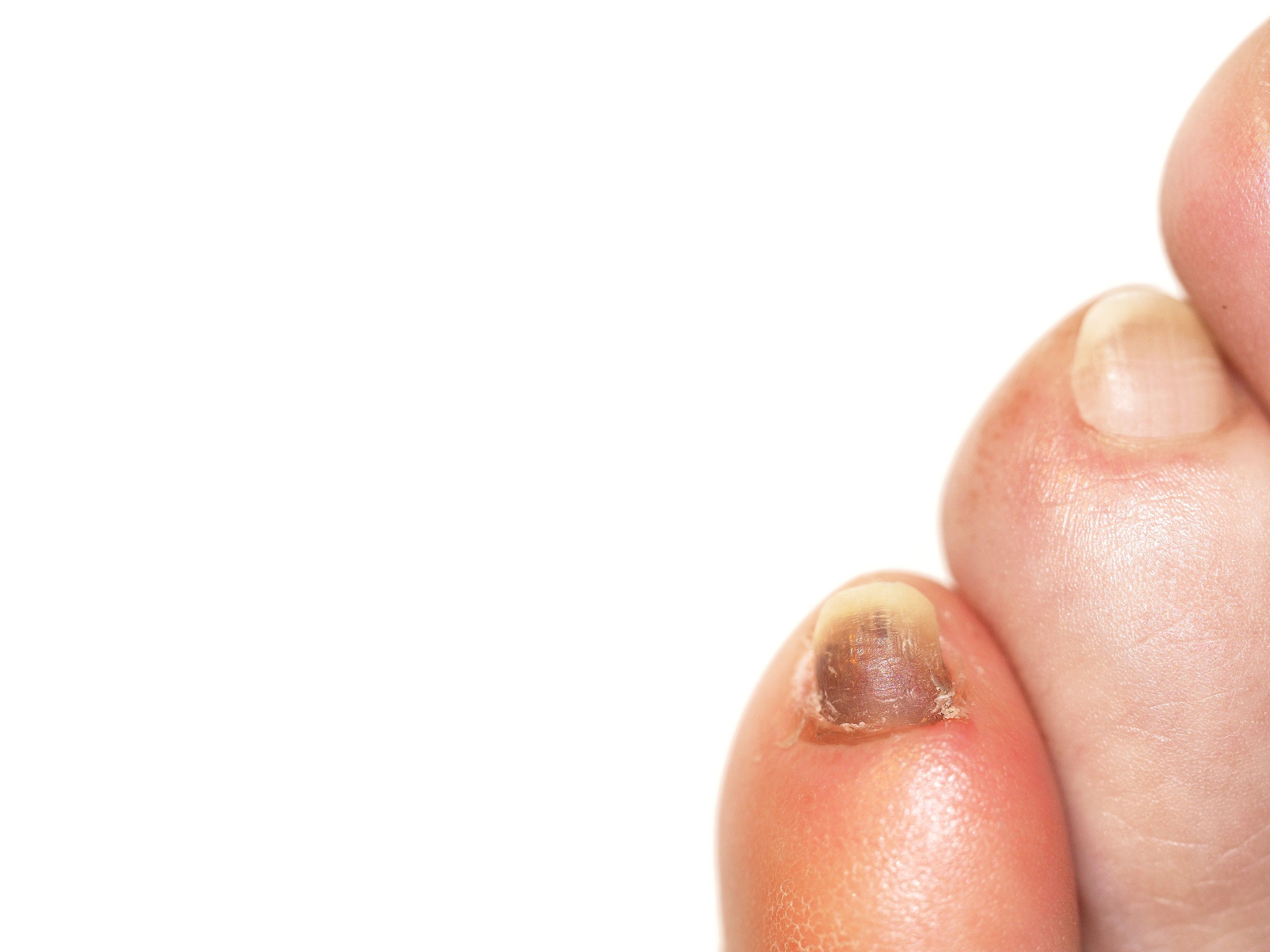 What The Color Of Your Toenails Says About Your Health Pulse Ghana