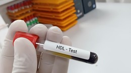 ¿Qué significa colesterol HDL bajo?  El experto explica