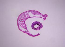 schistosomiasis története