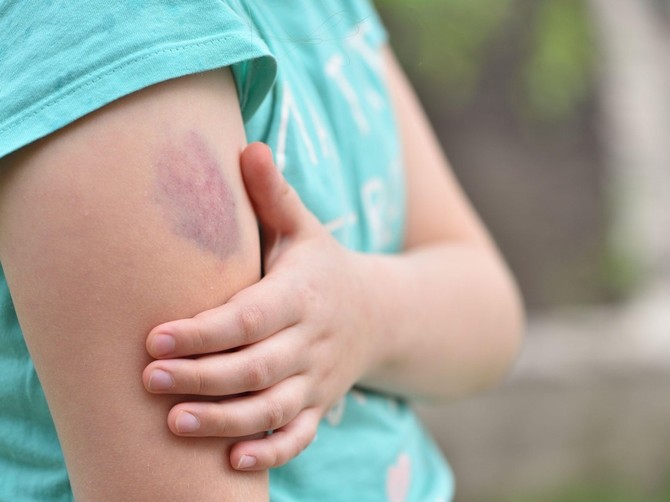 Najčešći klinički znak stečene hemofilije je iznenadna pojava modrica ili krvnih podliva na koži