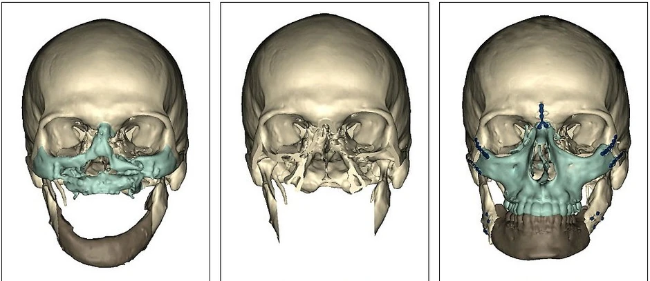 Na skeneru se vide prvobitne povrede na Norisovom licu (levo), zatim nakon uklanjanja i posle operacije (desno)