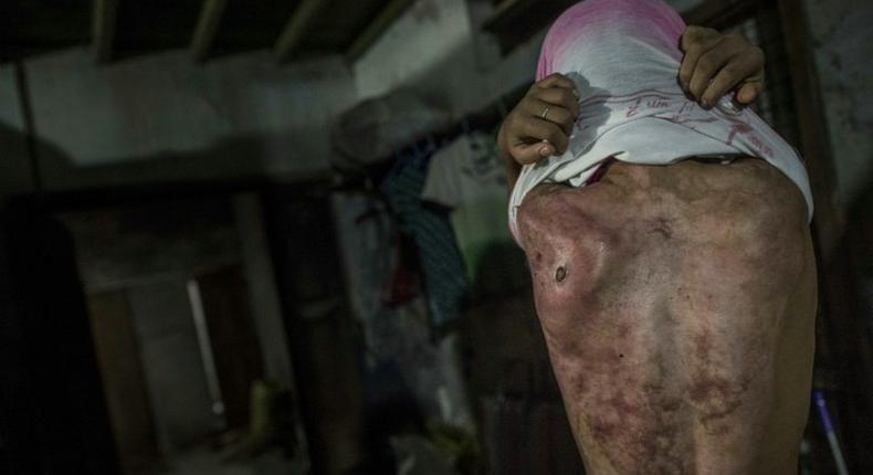 Former child servant, 14-year old Khin Khin Tun, shows the deep scars on her back at Mawlamyine, some 300 kms southeast of Yangon, on February 13, 2017