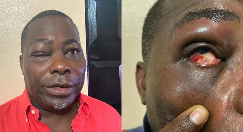 Photos: NPP’s Charles Bissue suffers bruised face after ‘fight’ with Tarkwa-Nsuem MP