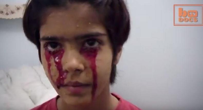 Twinkle, a 13-year-old girl from Indian spontaneously bleeds from her head, hands and feet.