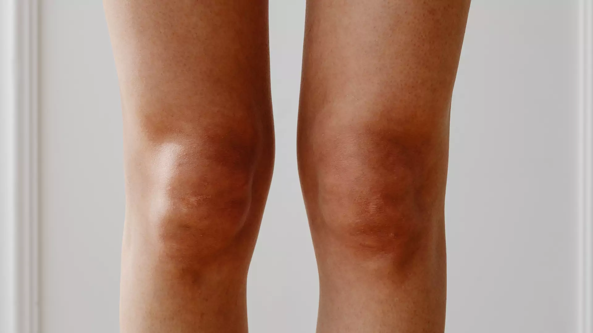 Twoje łokcie i kolana wyglądają, jakby były brudne? To może być objaw tych trzech chorób