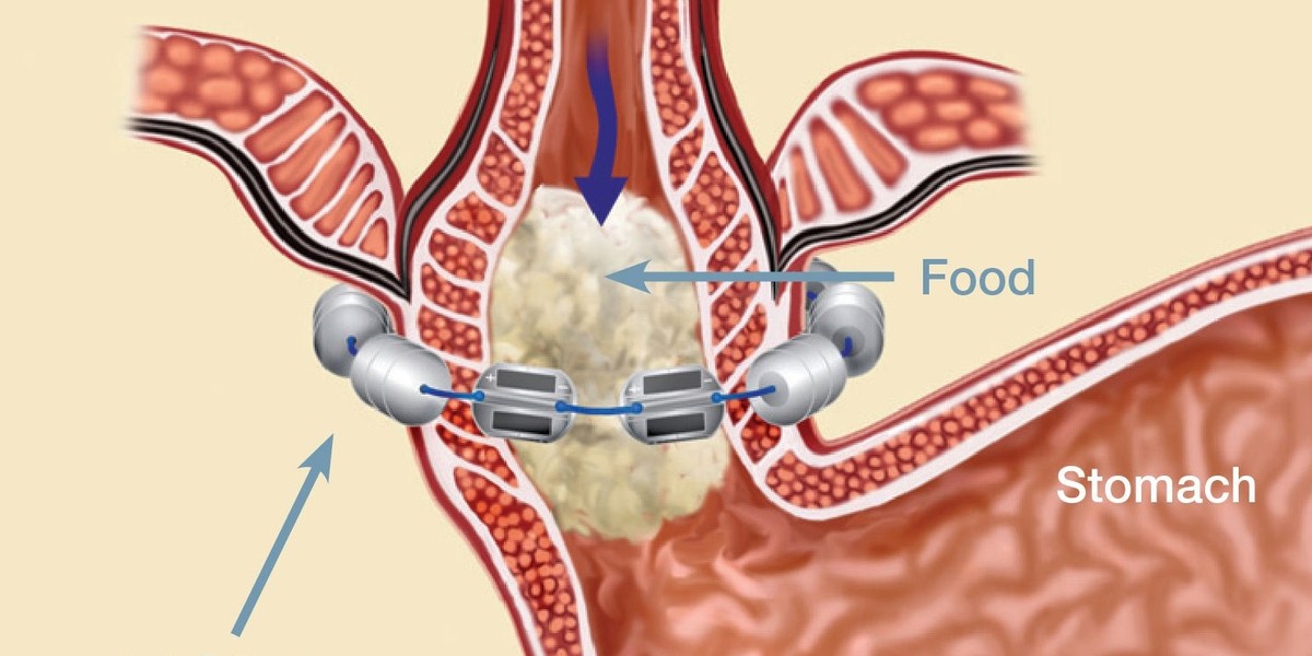 LINX Reflux Management System