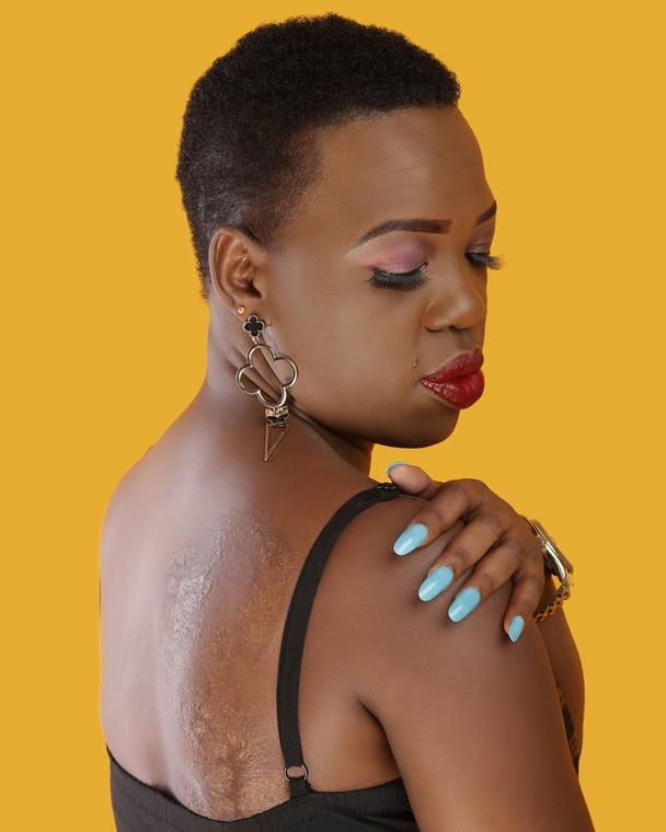 Ruth Matete shows her scars (Instagram) 