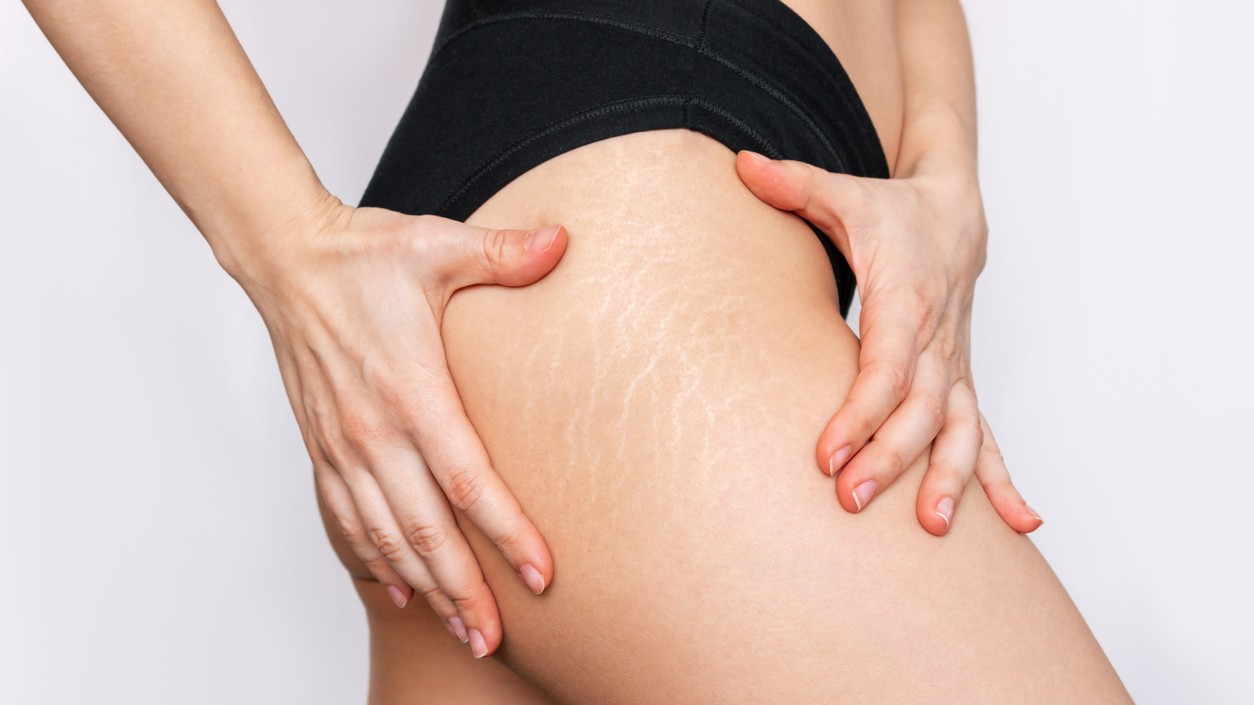 Prečo strie vznikajú aj deťom a ktoré zložky v kozmetike ich skutočne zjemnia?