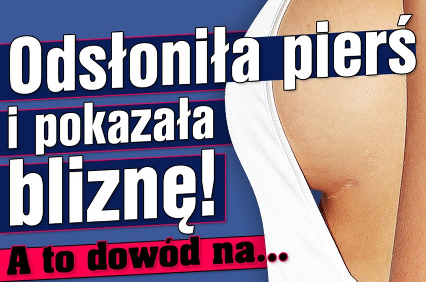 Odsłoniła pierś i pokazała bliznę A to dowód na