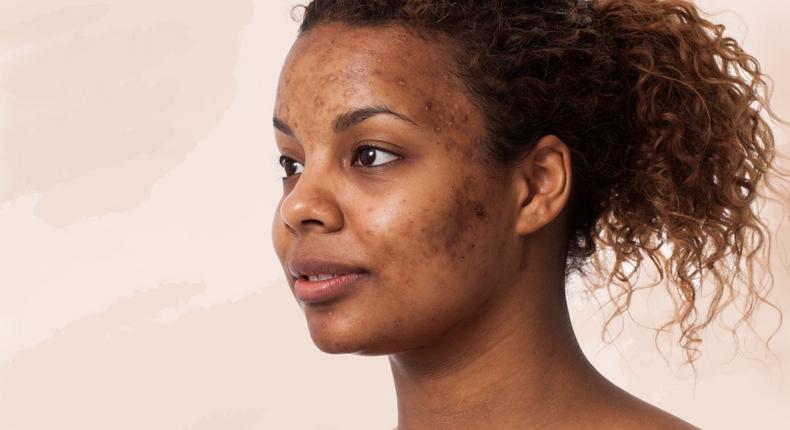 Woman with acne(Well+Good)