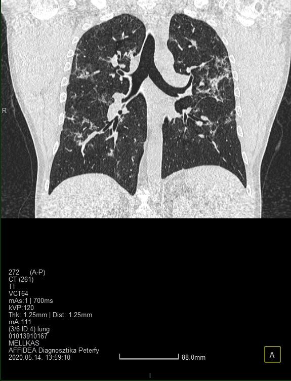 A koronavírussal fertőzött tüdőn sokáig látszanak a fertőzés okozta nyomok