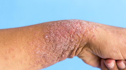 Emulsja dla chorych na atopowe zapalenie skóry wycofana z obrotu. Sprawdź numer serii