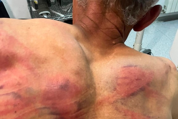 (UZNEMIRUJUĆE FOTOGRAFIJE) ODVELI GA U ŠUMU, VEZALI ZA DRVO I BRUTALNO TUKLI CREVOM ZA VODU! Jezivo nasilje tzv. kosovske policije nad Srbinom: Tražili da prizna da je počinio zločin