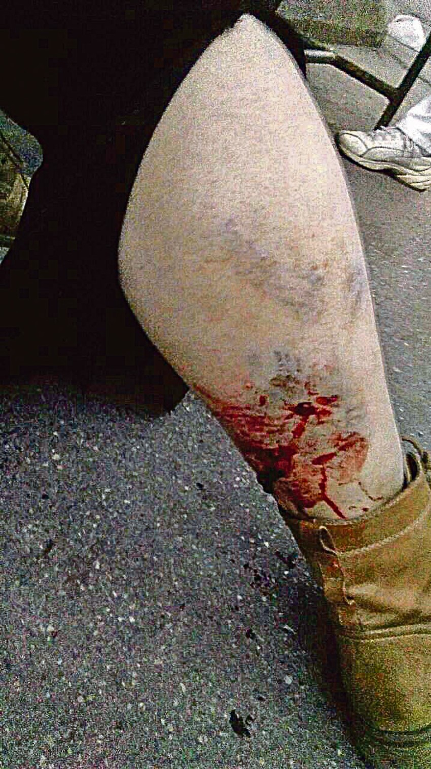 Bilo ih je šest, sedam i svi su bili ogromni: Zoričina noga posle napada