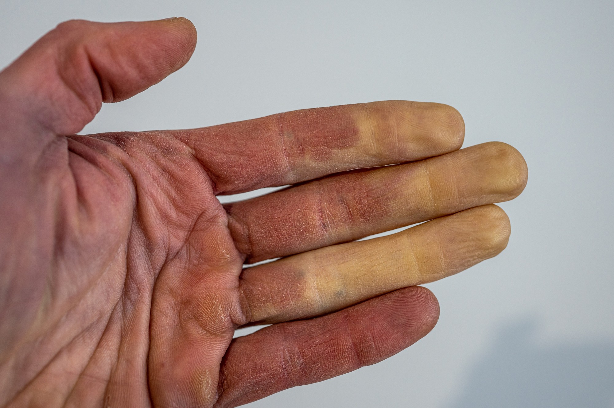 Boala Raynaud poate fi periculoasă.