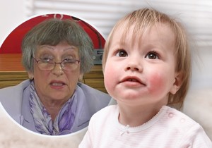 Od ukupnog broja obolelih od lupusa, 15 do 20 pacijenata ima manje od 18 godina, kaže dr Gordana Sušić, pedijatar reumatolog