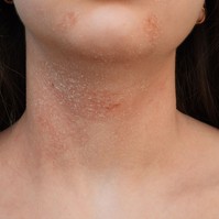 Mi okozza az atópiás dermatitiszt és hogyan kezelhető? Erről jó, ha tud!