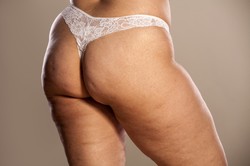 Do lata masz szansę się z nim rozprawić. Kosmetyki i ćwiczenia pomagające zwalczyć cellulit