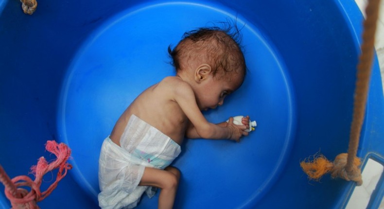 A Yemeni child suffering from malnutrition is weighed at a treatment centre in northern Hajjah province