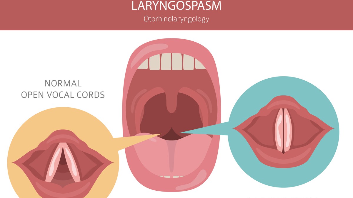Laringospazam