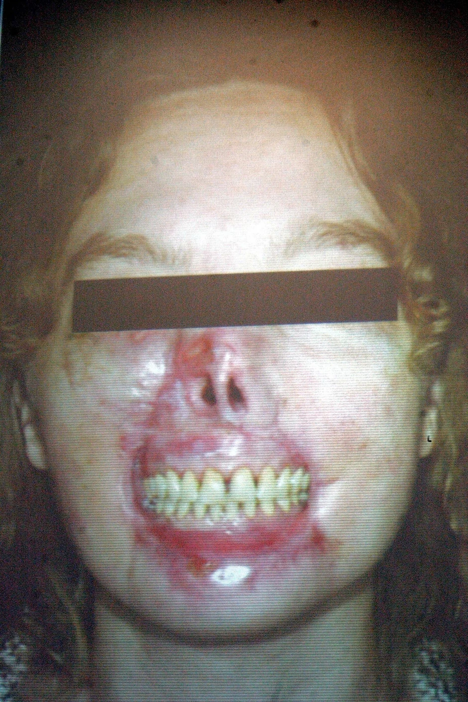 Isab Dinoir nakon što ju je pas izujedao