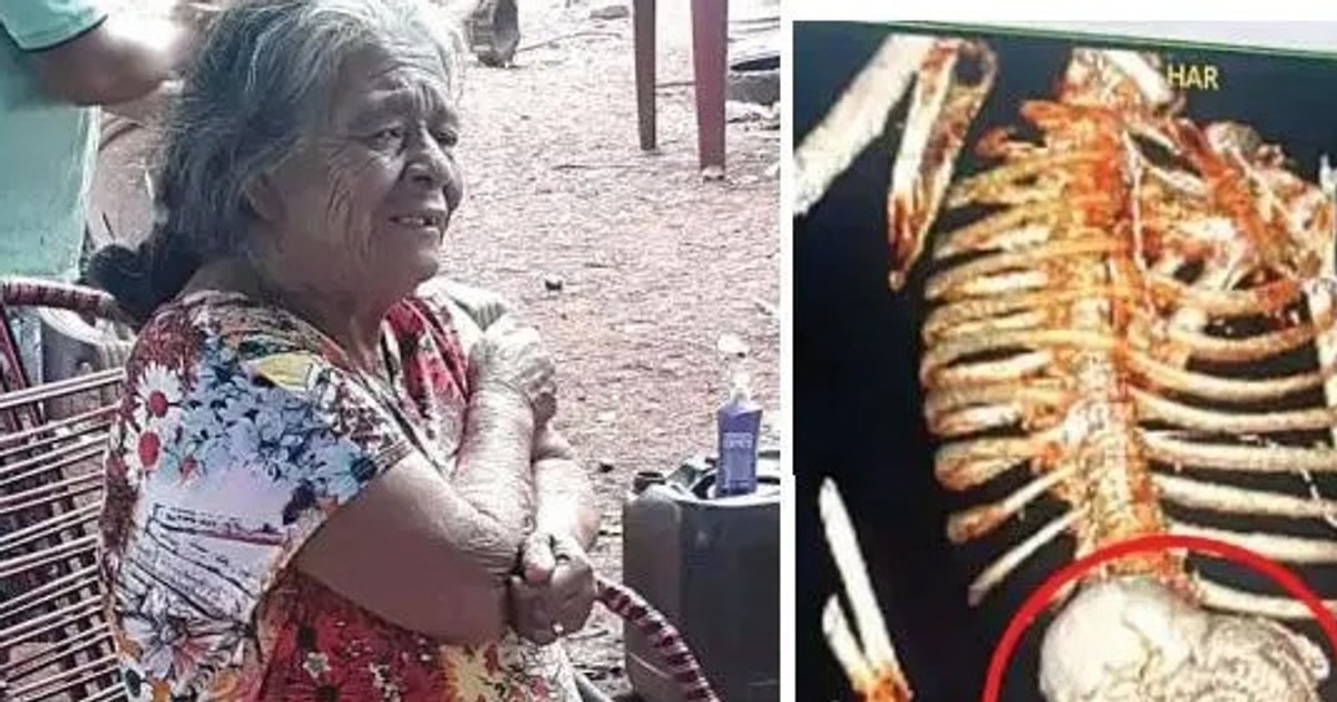Woman carries dead foetus for 56 years, dies after removal surgery - Vimarsana News