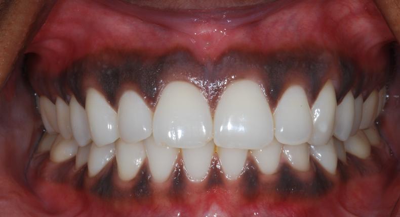 Black gums(Chrysalis Dental Centres)