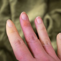 Ezért rosszabbodnak a Raynaud-szindróma tünetei hideg időben