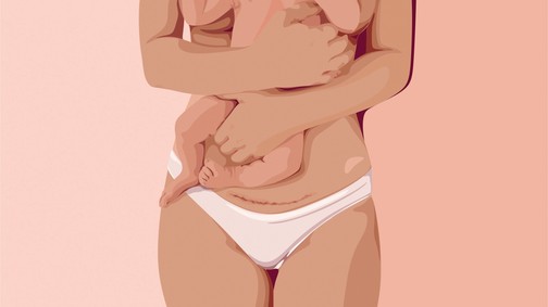 Császárvonal: A cél, hogy a nők császármetszés előtt és után minden információt megkapjanak