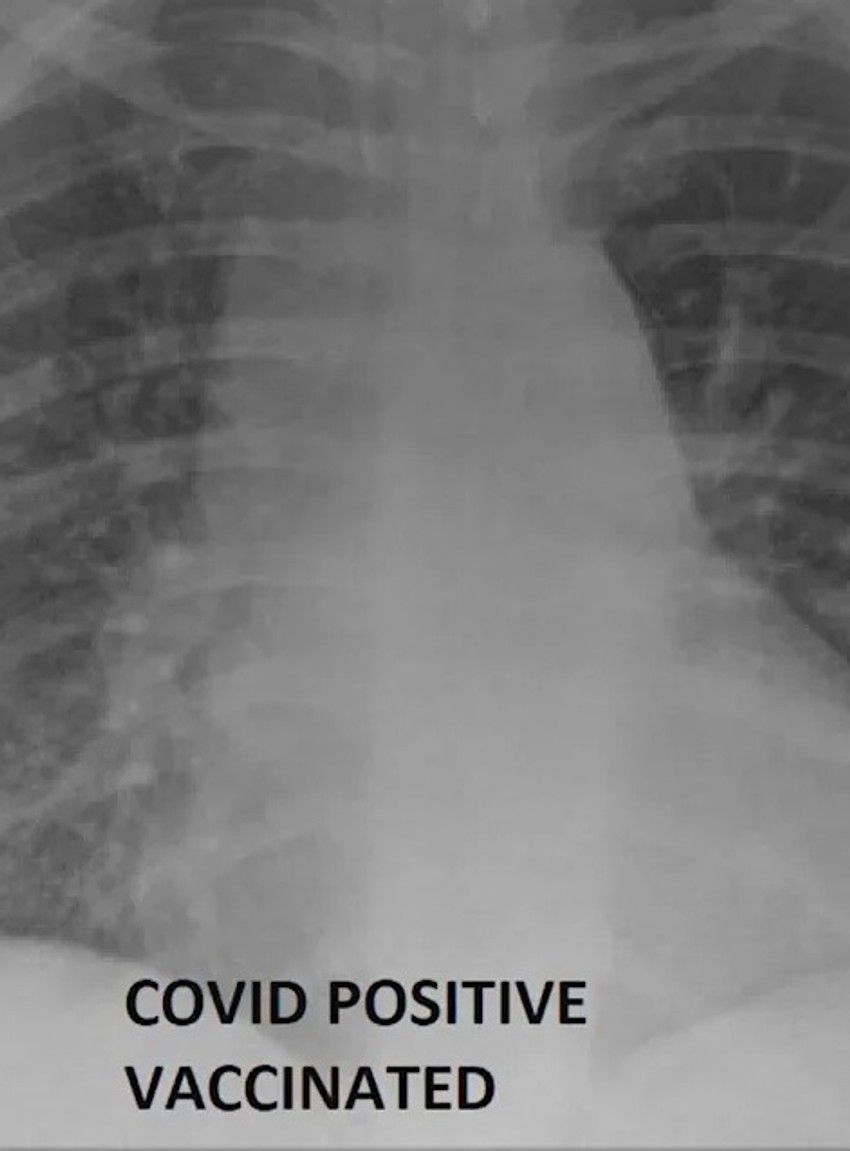 Rendgenski snimak vakcinisanog pacijenta obolelog od kovida