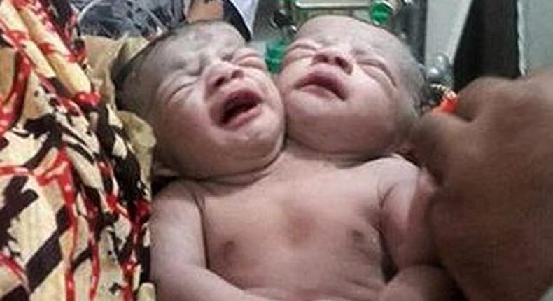 Two headed baby girl born in Bangladesh