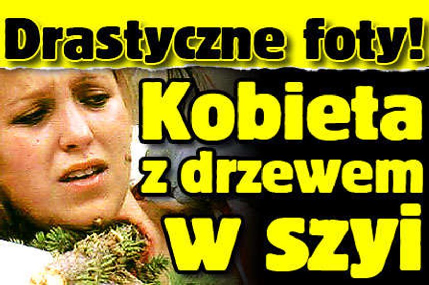 Drastyczne foty! Kobieta z drzewem w szyi