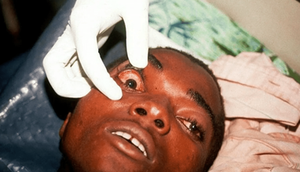 Marburg Virus (Healthnews)
