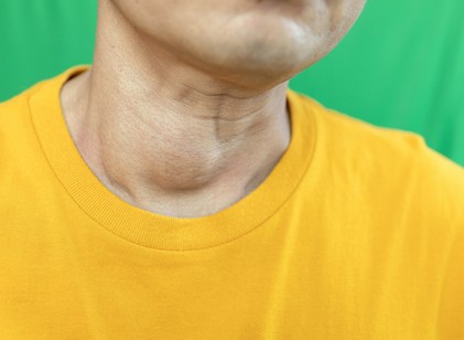 Mikor kell műteni a strúmát? Az endokrinológus válaszol című cikk nyitóképe