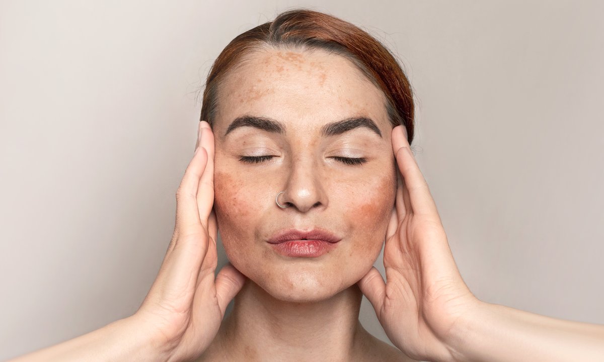 Ten krem działa na brązowe plamki jak wybielacz. Rozjaśnia przebarwienia jak laser