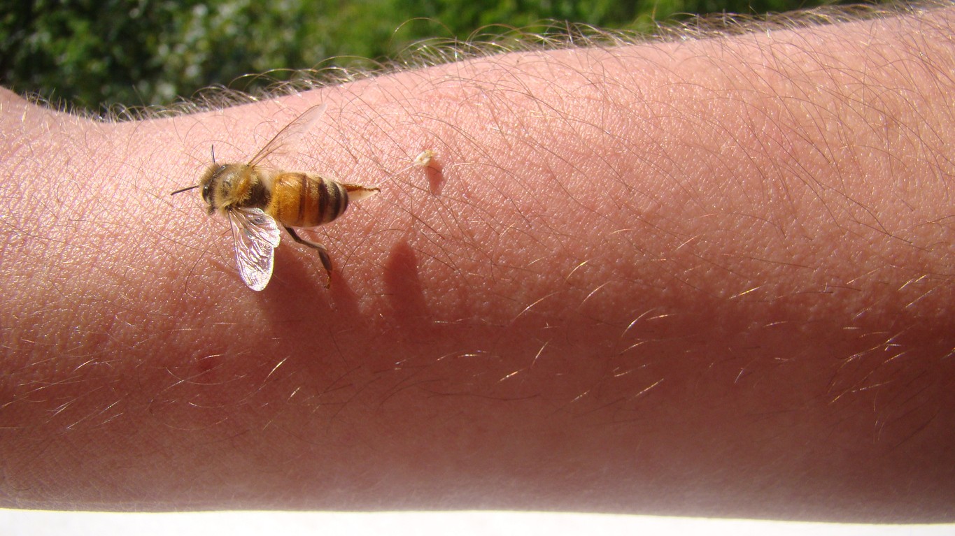 Rýchla prvá pomoc pri uštipnutí včelou a osou.