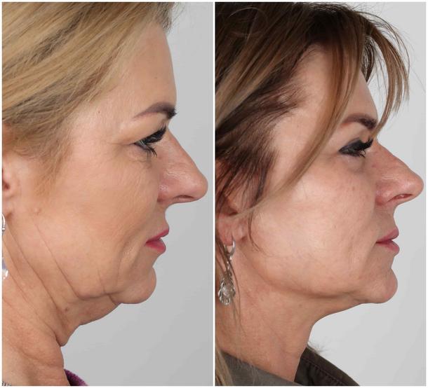 Efekt przed i po zabiegu liftingu twarzy