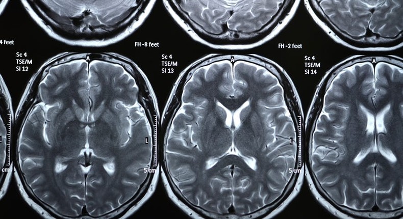 A brain scan showing gray matter.
