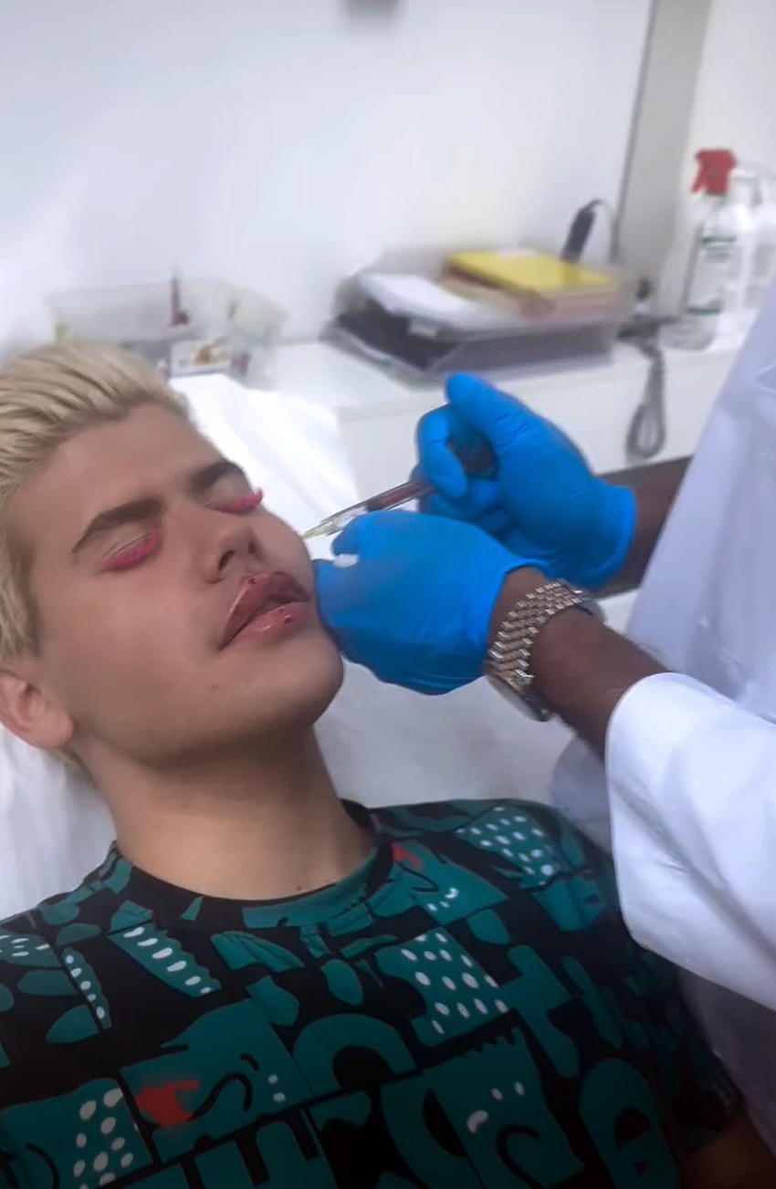 Uroš Stanić povećao usne i jagodice pred početak Elite 10