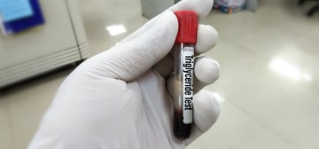 Mit jelent a triglicerid érték a laborleleten?