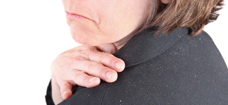 Fakty i mity na temat łupieżu. Można go pomylić z innymi chorobami!