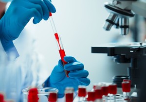 Kada je nizak nivo crvenih krvnih zrnaca to je anemija, nizak nivo belih krvnih zrnaca je leukopenija a trombocita trombocitopenija