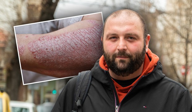 Zahvaljujući najsavremenim terapijama moguće osloboditi se od simptoma psorijaze, imati čistu kožu i voditi kvalitetniji život, kaže Vladimir Kecić