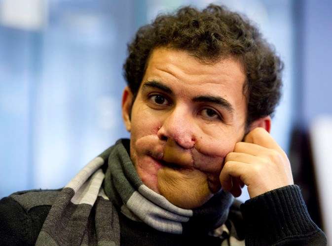 Przed berlińskimi chirurgami stało nie lada wyzwanie. Musieli zrekonstruować usta Mohameda, część jego nosa oraz całą szczękę. Lekarzom tak zależało na „naprawieniu” mężczyzny, że namówili dyrekcję szpitala, by koszt jednej ze szczególnie skomplikowanej operacji pokryć z kasy szpitalnej.