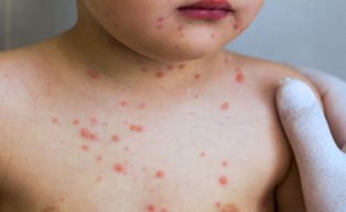 Ekspert: Wirus odry pochodzi z zagranicy. Przypadki zachorowań są rozproszone