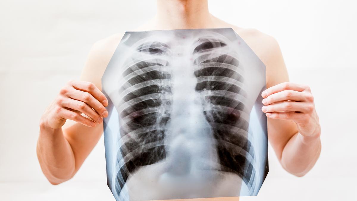 płuca prześwietlenie rak płuc nowotwór płuc rentgen x-ray