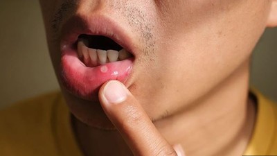 Mouth ulcer