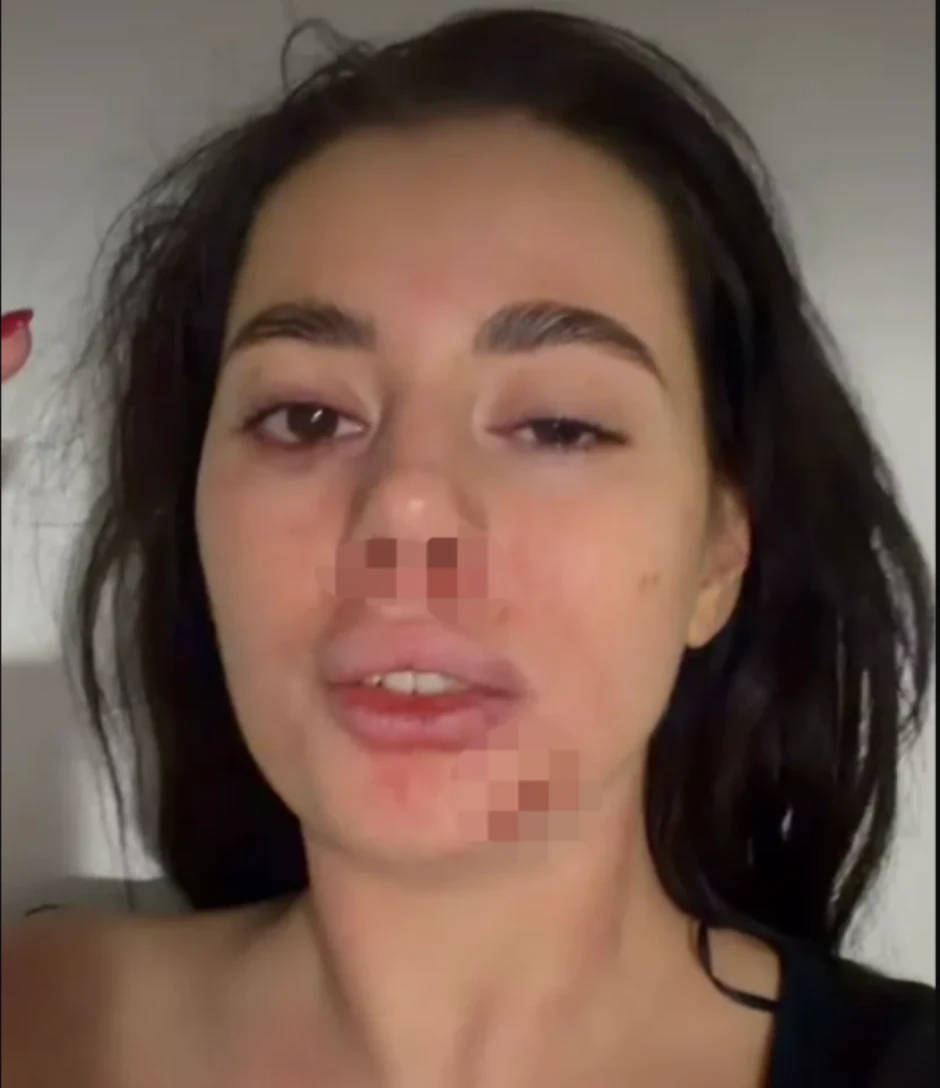 Jezive fotografije pretučene bivše rijaliti učesnice: "Devojke, pazite se"